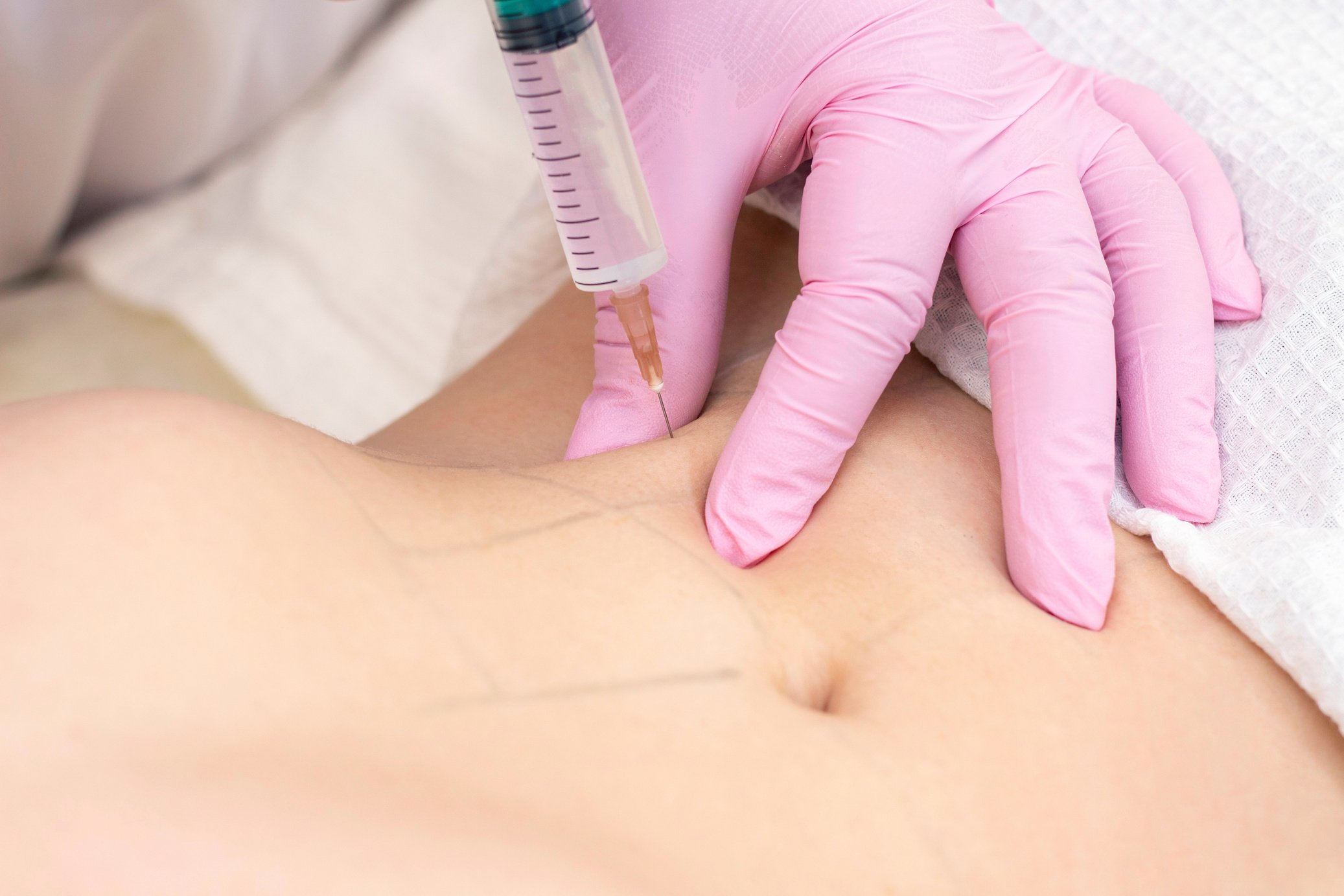 lipolytic injections are placed in the stomach. female hands in pink gloves inject a young woman into the stomach.